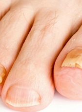 Симптомы и признаки грибка ногтей