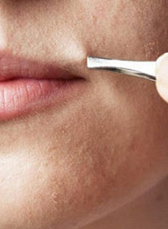 Волосы на лице | Удаление волос на лице в СМ-Косметология