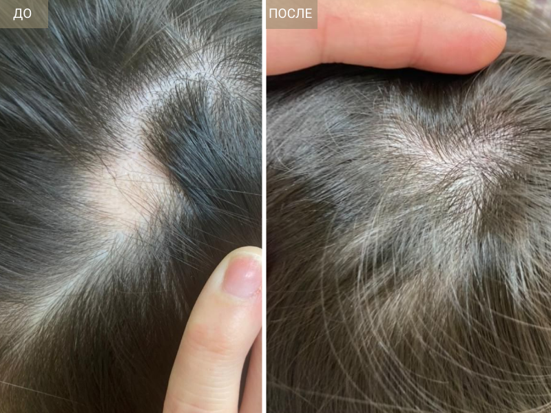 Как восстановить волосы после ковида | Лечение выпадения волос после  короновируса в «СМ-Косметология»