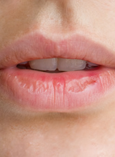Почему губы трескаются: основные причины и способы увлажнения