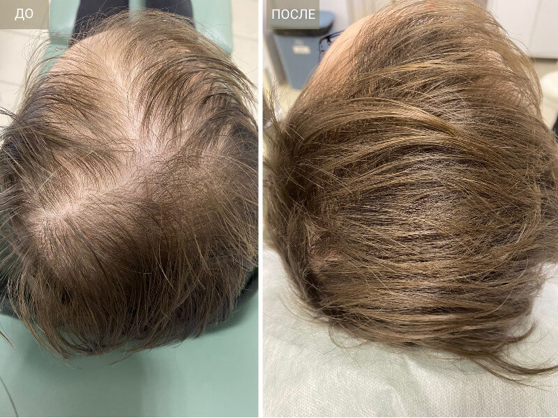 Как восстановить волосы после ковида | Лечение выпадения волос после  короновируса в «СМ-Косметология»